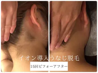 🎀うなじ脱毛🎀 ㅣLino堀江のエステ・リラクイメージ