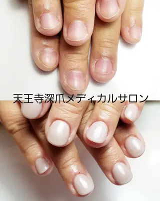 ネイル 天王寺 深爪メディカルサロンのネイルデザイン