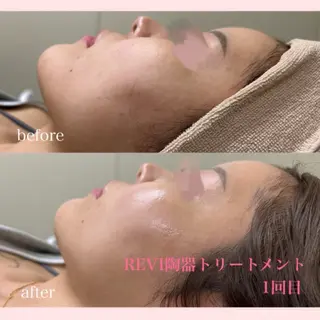 美容サロンAkazukin所属・REVI認定脱毛サ ロンAkazukinのエステ・リラクイメージ