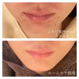 セミロング パーマ ヘアアレンジ メンズ キッズ ネイル マツエク・マツパ ニキビ跡専門サロン Ainaのエステ・リラクイメージ