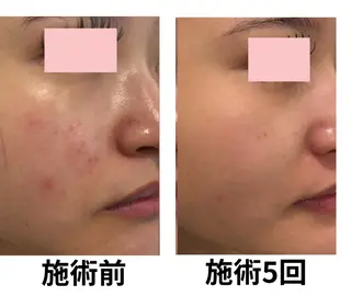 毛穴・ニキビ専門 エステグレースティーのエステ・リラクイメージ