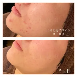 ミディアム カラー パーマ ヘアアレンジ メンズ キッズ ネイル マツエク・マツパ ニキビ跡専門サロン Ainaのエステ・リラクイメージ