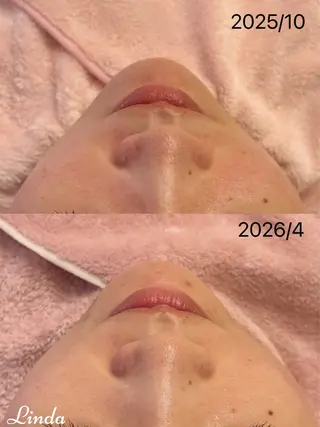 小顔&毛穴・肌質改善 LINDA西宮 AIのその他イメージ