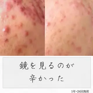 ニキビ経験者が施術 する専門サロン🌻のエステ・リラクイメージ