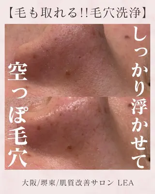 Lea堺東　毛穴洗浄 ×顔ワックス脱毛のその他イメージ