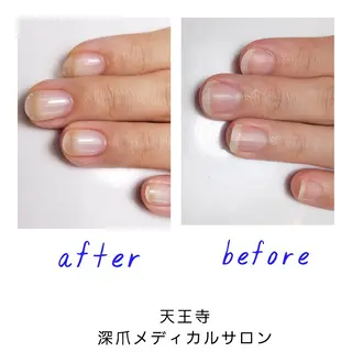ネイル 天王寺 深爪メディカルサロンのネイルデザイン