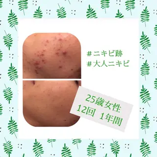 ミディアム カラー パーマ ヘアアレンジ メンズ キッズ ネイル マツエク・マツパ ニキビ・肌質改善専門 ♡人生が変わるサロンのエステ・リラクイメージ