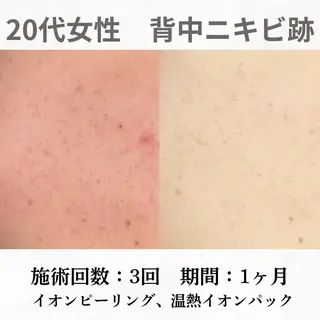 重度ニキビ専門🌷 ダウンタイムなしのエステ・リラクイメージ