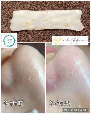 毛穴黒ずみ改善🥇 ✨シフォン豊田✨のエステ・リラクイメージ