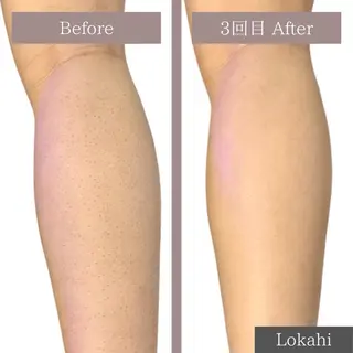 脱毛サロン Lokahiのエステ・リラクイメージ