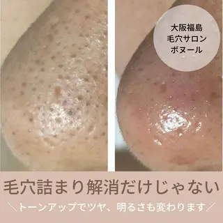 毛穴ケア・肌質改善 徳川のエステ・リラクイメージ