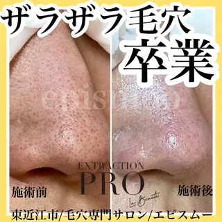 メンズ epismoo 脱毛/HBL/毛穴の眉毛・アイブロウイメージ