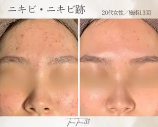 ピーリング×肌管理 THREETHREEのエステ・リラクイメージ