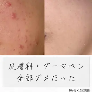 ニキビ経験者が施術 する専門サロン🌻のエステ・リラクイメージ