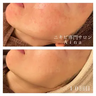 セミロング カラー パーマ ヘアアレンジ メンズ キッズ ネイル マツエク・マツパ ニキビ跡専門サロン Ainaのエステ・リラクイメージ