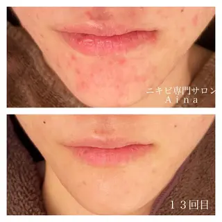 セミロング カラー パーマ ヘアアレンジ メンズ キッズ ネイル マツエク・マツパ アイブロウ ニキビ跡専門サロン Ainaのエステ・リラクイメージ