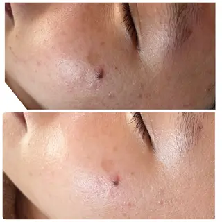 毛穴・ニキビ改善 girasoleのエステ・リラクイメージ