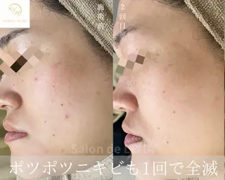 ハーブピーリング専門 サロンドレナ　白藤のエステ・リラクイメージ