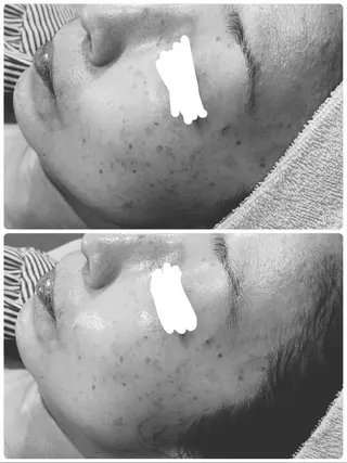 肌質改善/都度脱毛 Mahinaのエステ・リラクイメージ