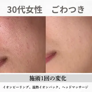 重度ニキビ専門🌷 ダウンタイムなしのエステ・リラクイメージ