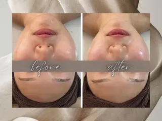 小顔・毛穴/ニキビ/ ハーブピーリング専門のエステ・リラクイメージ