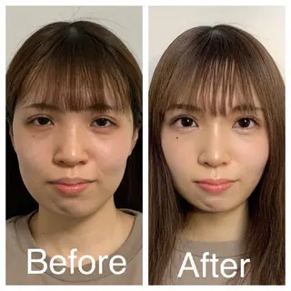 医療提携Ruby小顔 ハーブピーリングのその他イメージ