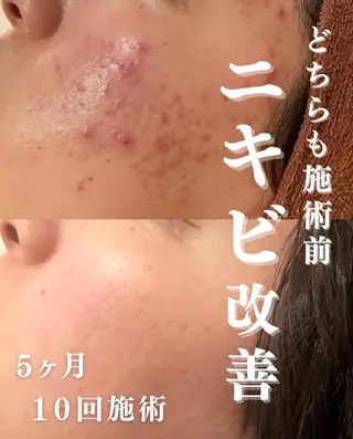 3か月で肌革命👼 ニキビ専門店💫のエステ・リラクイメージ