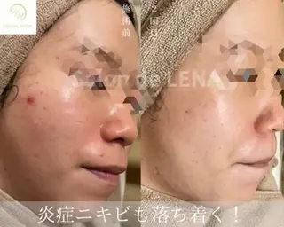 ハーブピーリング専門 グランディール　武内のエステ・リラクイメージ