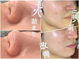 【ハーブピーリング/韓国ツヤ肌ピーリング】RelierBelle-ルリエベル-所属・肌質改善/肌育特化 プライベートサロンのエステ・リラクイメージ