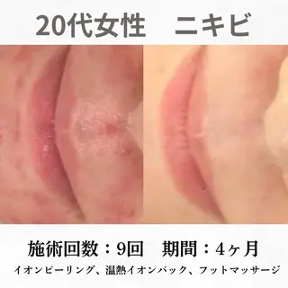 重度ニキビ専門🌷 ダウンタイムなしのエステ・リラクイメージ