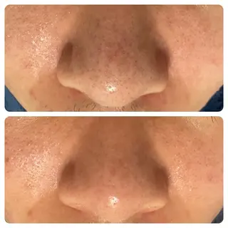 【赤ニキビ改善】 BELL'ET新宿店のエステ・リラクイメージ