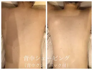🎀うなじ脱毛🎀 ㅣLino堀江のエステ・リラクイメージ