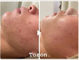 メンズ LOUISE. ／肌質・頭皮のエステ・リラクイメージ