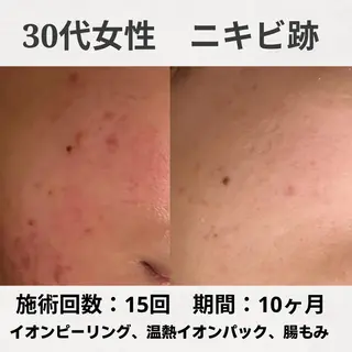 ニキビ跡改善専門🔥 医療にはできない改善のエステ・リラクイメージ
