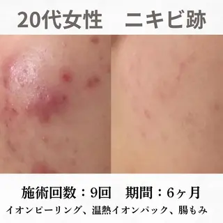 重度ニキビ専門🌷 ダウンタイムなしのエステ・リラクイメージ