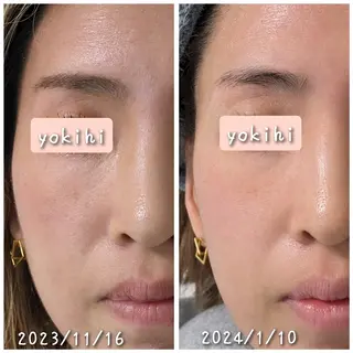 結果が出るスキンケア 肌質改善/まつパのエステ・リラクイメージ