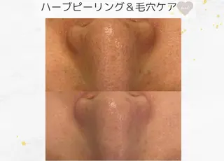 小顔/毛穴/ニキビ salon bealのエステ・リラクイメージ