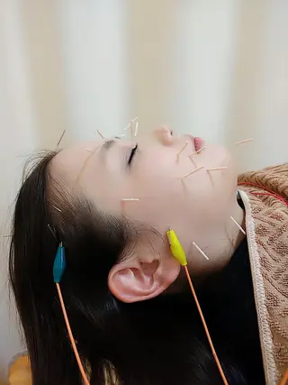 リフトアップ・たるみ ☆美容鍼小顔矯正のその他イメージ