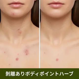 ハーブピーリング肌 管理🌿Ante関内のエステ・リラクイメージ