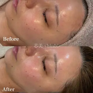 毛穴・ニキビケア ￤肌質改善￤EMIのエステ・リラクイメージ