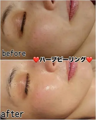 ハーブピーリング専門 毛穴洗浄❤️眉waxのエステ・リラクイメージ