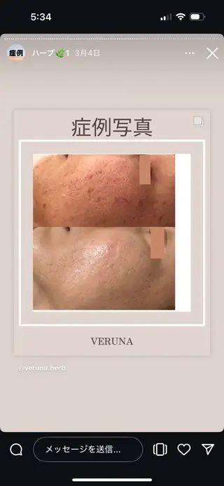 キッズ ハーブピーリング専門 グランディール　武内のエステ・リラクイメージ