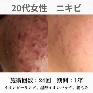 重度ニキビ専門🌷 ダウンタイムなしのエステ・リラクイメージ