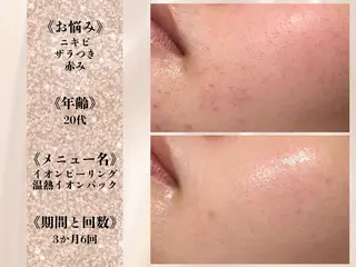ニキビ跡改善専門🔥 医療にはできない改善のエステ・リラクイメージ