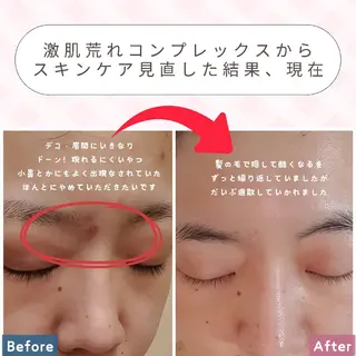 痩身ハーブピーリング 筋膜リリース☆B&Hのエステ・リラクイメージ