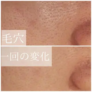 ロング カラー パーマ ヘアアレンジ メンズ キッズ ネイル マツエク・マツパ アイブロウ 3か月で肌革命👼 ニキビ専門店💫のエステ・リラクイメージ
