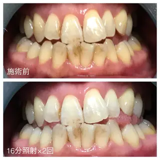 ネイル/耳つぼ /新ホワイトニングのネイルデザイン