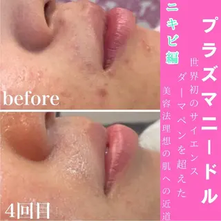WAX・肌質改善・毛 穴洗浄/林愛真のエステ・リラクイメージ