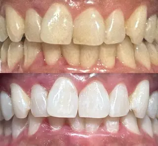 io teeth careのその他イメージ