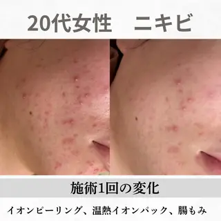 重度ニキビ専門🌷 ダウンタイムなしのエステ・リラクイメージ